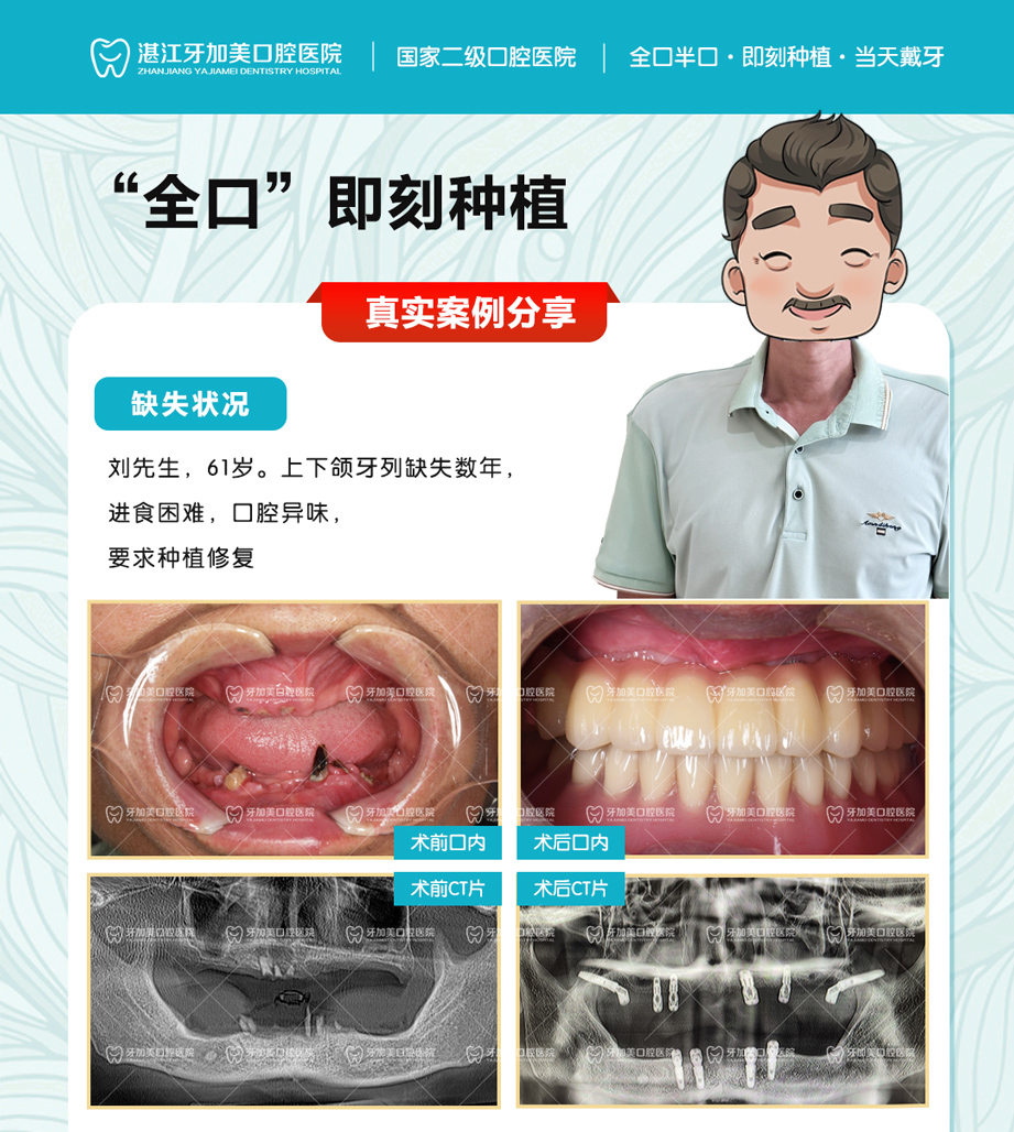 10种植案例（全口）刘德章 拷贝111.jpg
