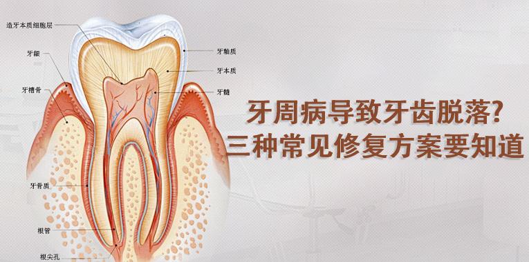 牙周病导致牙齿脱落，三种常见修复方案要知道