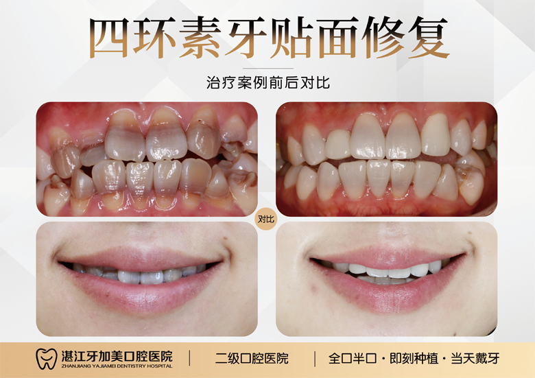 四环素牙贴面案例11png.png