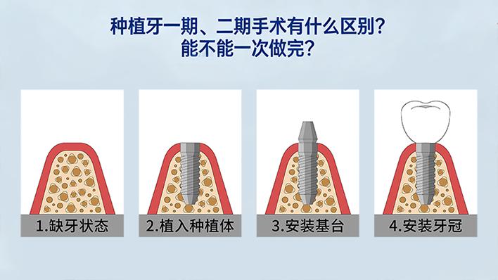 种植牙一期、二期手术有什么区别？能不能一次做完？