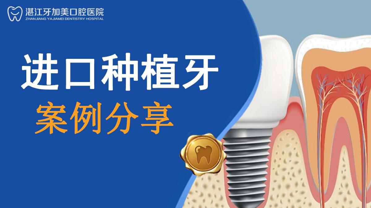 想种牙担心种不了？湛江牙加美口腔医院半口种牙案例分享！